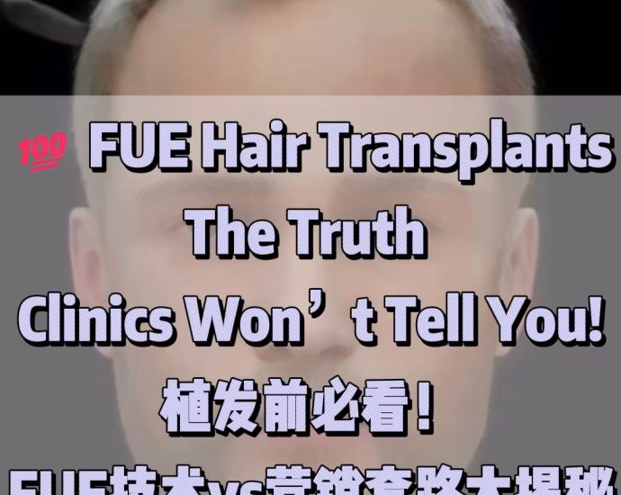 FUE Hair Transplants: The Truth Clinics Won’t Tell You! 10 FUE Hair Transplants: The Truth Clinics Won’t Tell You!植发前必看!FUE技术vs营销套路大揭秘